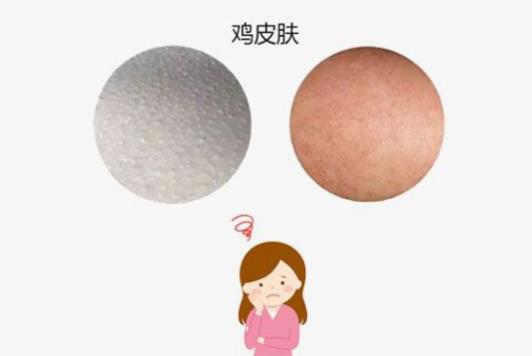 用什么去雞皮膚最有效 去雞皮膚不能“頂風(fēng)作浪”