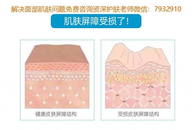 激素臉真是太痛苦了,使用朵嘉濃護膚品并堅持這四步助你擺脫激素臉 002.jpg