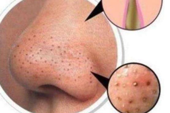 毛孔粗就會有黑頭 祛除黑頭別入這五個誤區