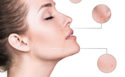 能夠有效預防青春痘的十大方法 有預防青春痘效果的食物