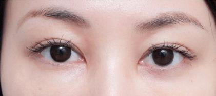 快速去眼袋方法 在家去眼袋 不用頂著眼袋出門