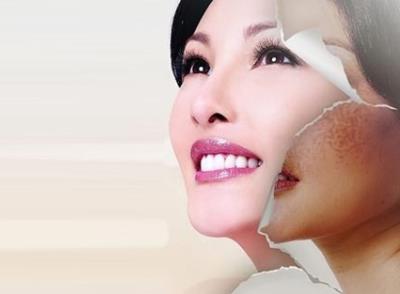 激光可以祛斑嗎?激光可以去除哪些斑