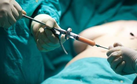 抽脂術(shù)的效果和注意事項(xiàng) 在決定抽脂前需要知道的幾件事