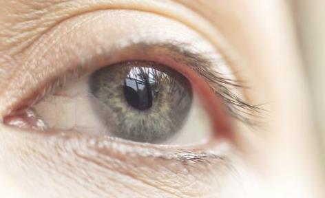 激光去眼袋有什么樣的優(yōu)勢(shì) 激光祛眼袋該注意什么