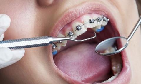 牙齒矯正的最佳年齡 牙齒矯正手術(shù)有什么樣的危害