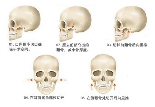顴骨增高手術(shù)適合哪些人做?顴骨增高手術(shù)的注意事項(xiàng)