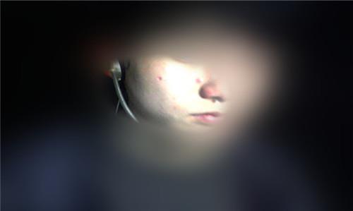 點(diǎn)痣好不好會(huì)留疤嗎?點(diǎn)痣后要注意什么