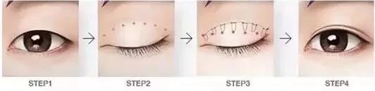 鄭州美萊整形靠譜么 重塑優美弧線靈韻精雕大眼