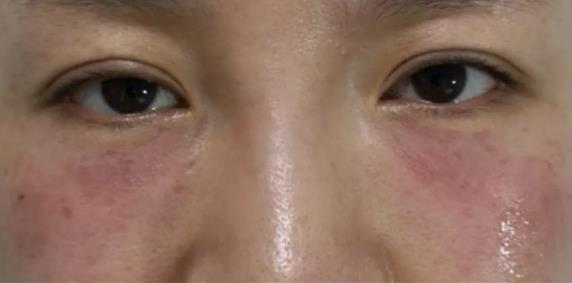 廈門薇格醫院做眼部整形專業嗎 讓您更美一點