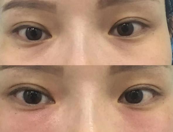 廈門薇格醫院做眼部整形專業嗎 讓您更美一點