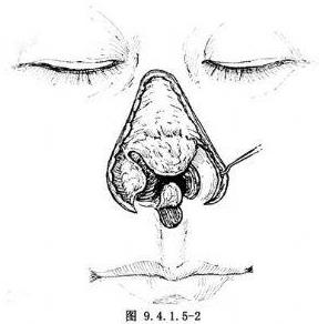 廈門臉博士整形醫(yī)院可信嗎 拉斯鼻整形修復(fù)技術(shù)免費(fèi)拯救了這個(gè)無鼻小孩