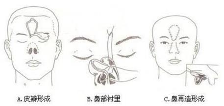 廈門臉博士整形醫(yī)院可信嗎 拉斯鼻整形修復(fù)技術(shù)免費(fèi)拯救了這個(gè)無鼻小孩