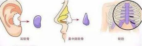 北京伊美爾醫療醫院:鼻唇溝是哪里