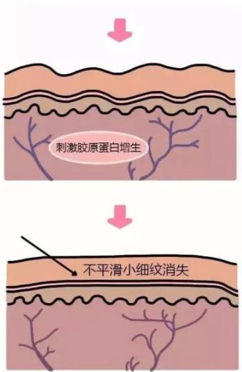 北京伊美爾紫竹醫(yī)院:光子嫩膚多久做一次