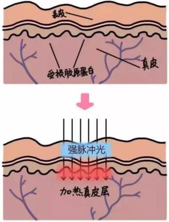 北京伊美爾紫竹醫(yī)院:光子嫩膚多久做一次