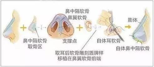 北京伊美爾醫療醫院:鼻唇溝是哪里