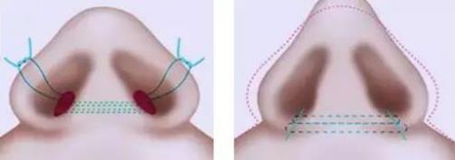 北京伊美爾醫療醫院:鼻唇溝是哪里