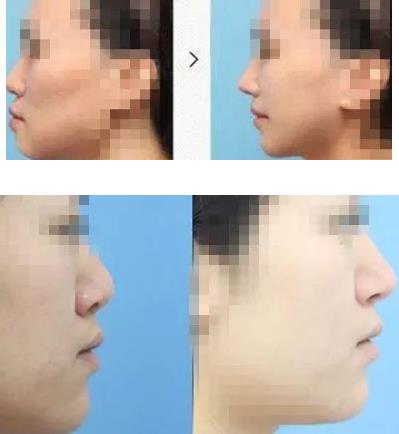 北京伊美爾醫療醫院:鼻唇溝是哪里