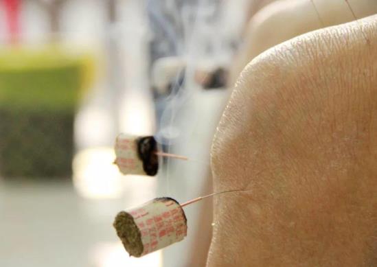 針灸減肥要堅持多久才行?針灸減肥幾次一個療程?