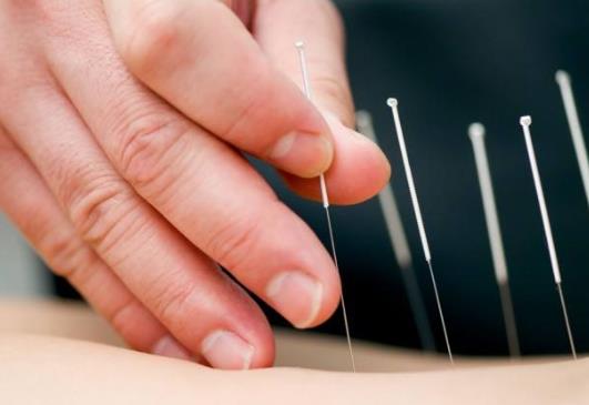 針灸減肥一個月能瘦多少斤?針灸減肥需要配合運動嗎?