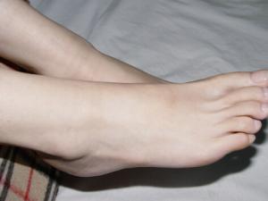 腳上長雞眼怎么辦?如何預防腳上長雞眼