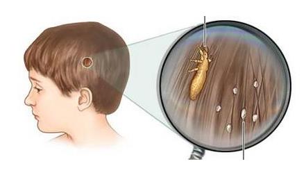 頭上長虱子怎么辦?虱子怎么去除?去虱子和虱子卵的有效方法