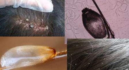 頭上長虱子怎么辦?虱子怎么去除?去虱子和虱子卵的有效方法