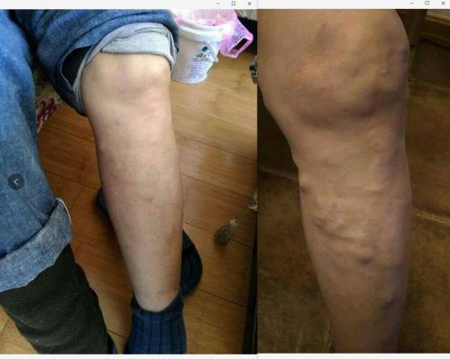 曲康健,在我靜脈曲張手術反復后又看到了健康希望