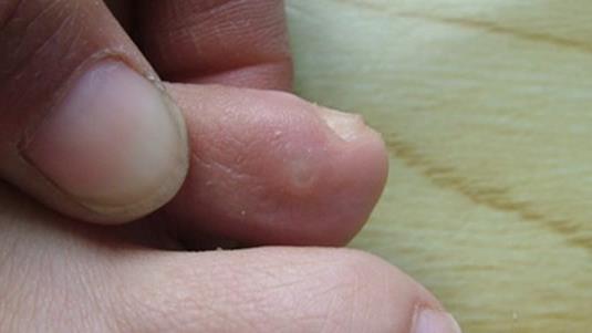 雞眼剛開始的圖片及初期癥狀、雞眼的形成原因及治療方法