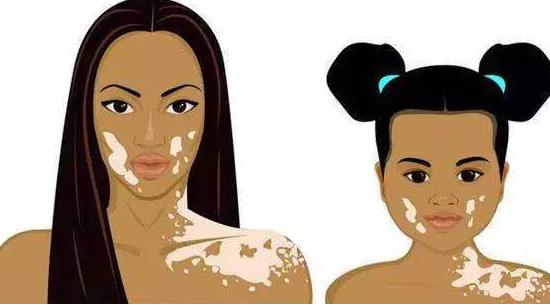 ?白癜風有哪些癥狀?患白癜風的原因有哪些?