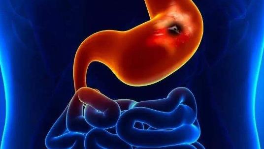 患十二指腸潰瘍有哪些并發癥?怎么預防十二指腸潰瘍?