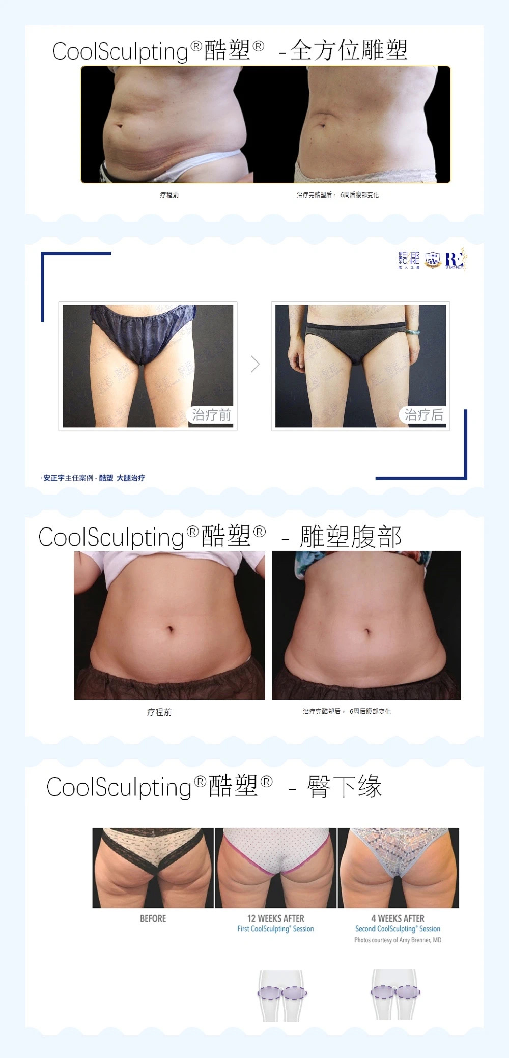 在北京藝星嘗試了酷塑冷凍減脂后,她的小肚腩竟然“躺著瘦”不見了!