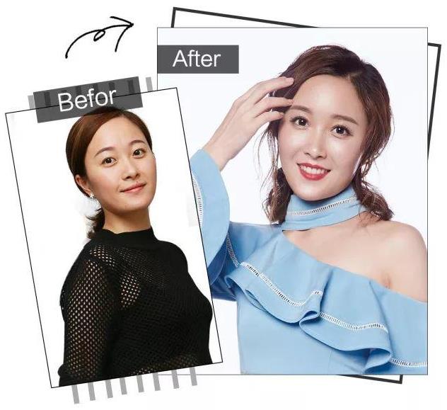 昆明銅雀臺趙蘭明主任 自體脂肪填充 全城征集3000張少女臉