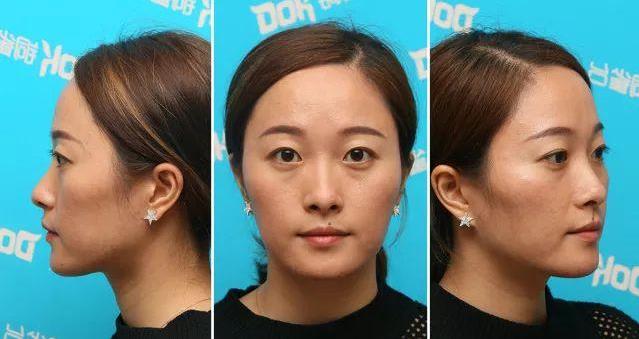 昆明銅雀臺趙蘭明主任 自體脂肪填充 全城征集3000張少女臉