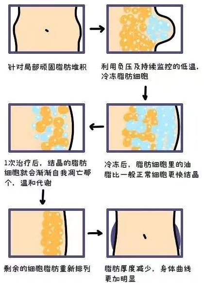 在北京藝星嘗試了酷塑冷凍減脂后,她的小肚腩竟然“躺著瘦”不見了!