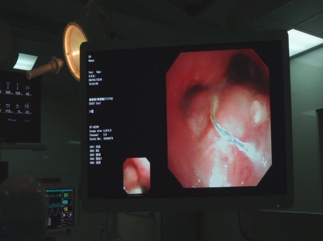 廣東哪家能看好腫瘤暨南大學附屬復大腫瘤醫院