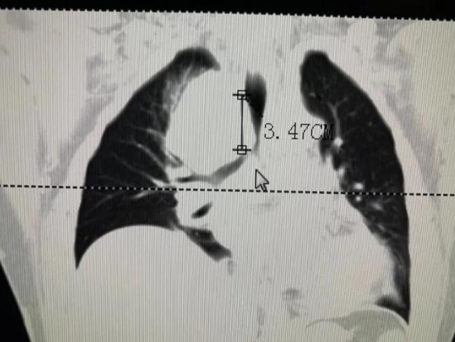 廣東哪家能看好腫瘤暨南大學附屬復大腫瘤醫院