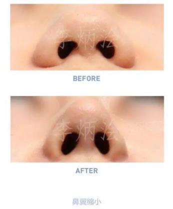 隆鼻再修復 高難度修復 美憬醫療修復基地 李炳澮教授