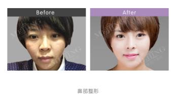 隆鼻再修復 高難度修復 美憬醫療修復基地 李炳澮教授