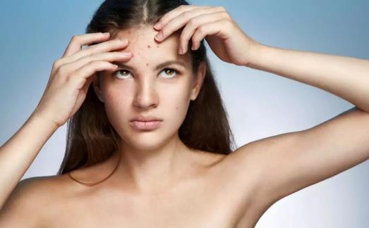 臉上長痘是因為熬夜嗎 為什么有的人熬夜不長痘痘