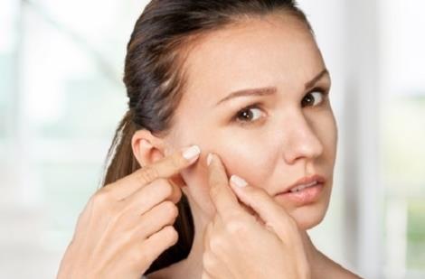 臉上長痘是因為熬夜嗎 為什么有的人熬夜不長痘痘