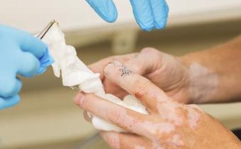 為什么男性白癜風(fēng)更容易擴(kuò)散?新軍都醫(yī)院男性白癜風(fēng)診療專家趙河臣主任總結(jié)了這些原因