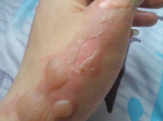 手上燙紅了一塊怎么辦?燙傷的水泡可以刺破嗎