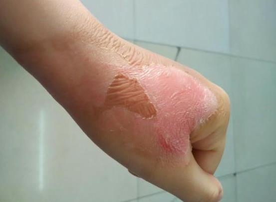 手上燙紅了一塊怎么辦?燙傷的水泡可以刺破嗎