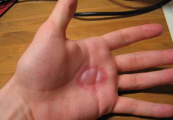 手上燙紅了一塊怎么辦?燙傷的水泡可以刺破嗎