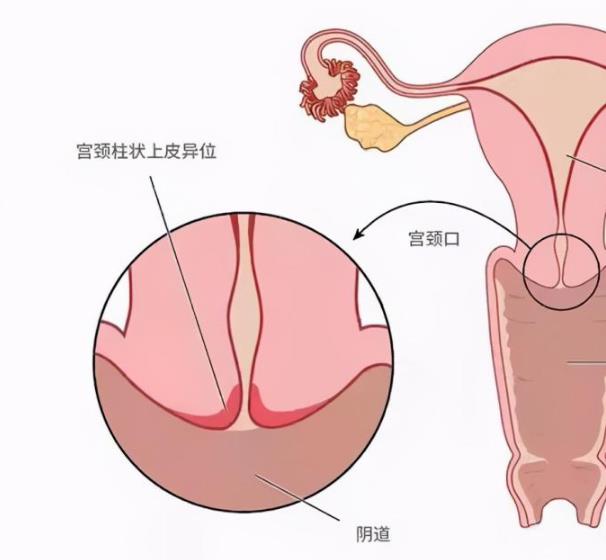 武漢仁愛醫院婦科:宮頸疾病,女人的紅顏禍“水”!!