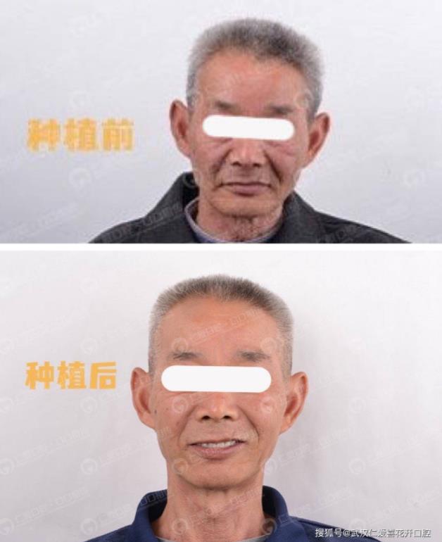 武漢仁愛口腔 重回青春——74歲老人自述種植牙全過程