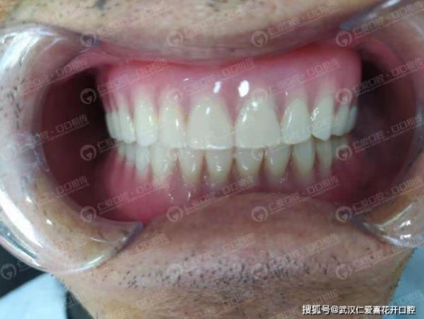 武漢仁愛口腔 重回青春——74歲老人自述種植牙全過程
