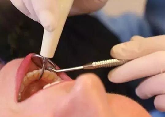 為什么早上拔牙比較好?拔牙第二天可以上班嗎