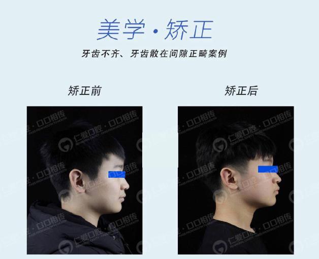 武漢仁愛口腔牙齒矯正技術(shù)好不好?